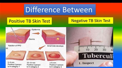 cvs tuberculosis test|Tuberculin Skin Test .